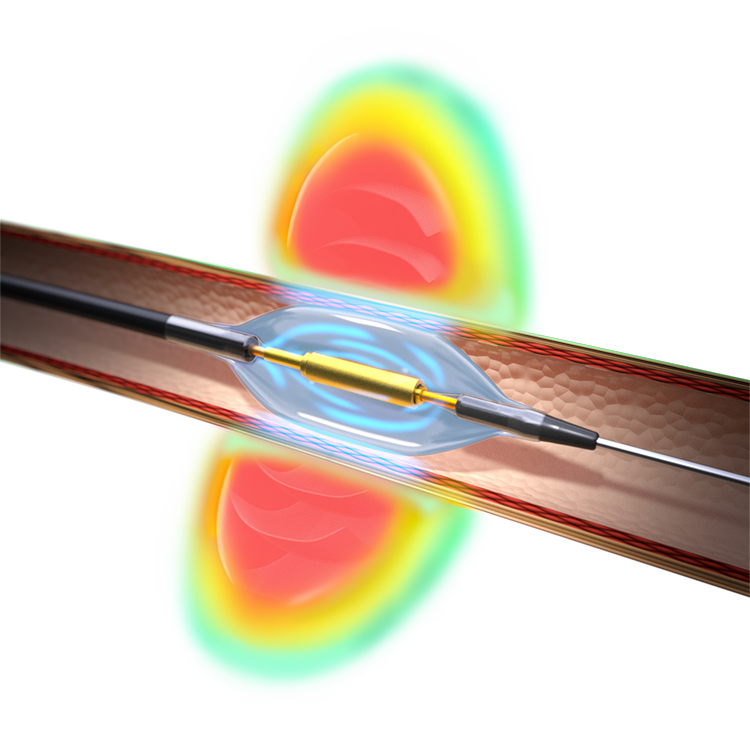 Paradise 3D Cath-Sonication 10-2022.png